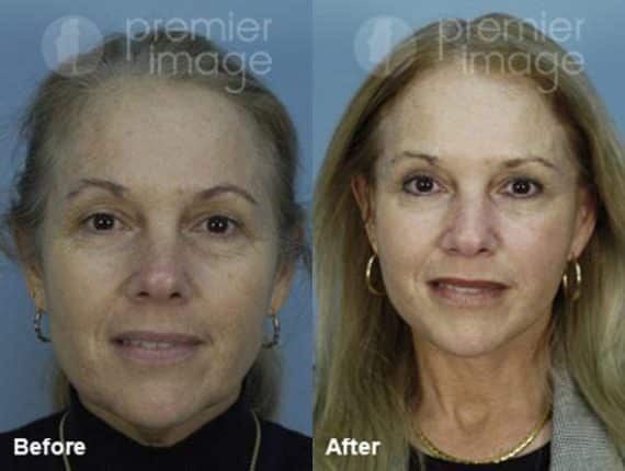 QT Mini-Facelift Before and after photos in Sandy Springs, GA, Patient 16128