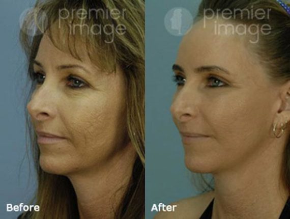 QT Mini-Facelift Before and after photos in Sandy Springs, GA, Patient 16135