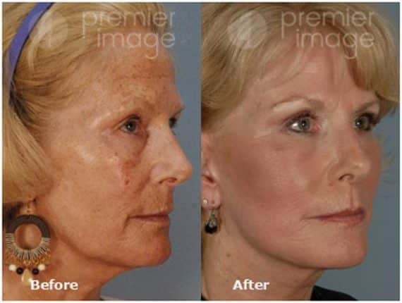 QT Mini-Facelift Before and after photos in Sandy Springs, GA, Patient 16142