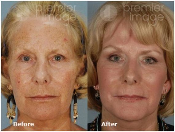 QT Mini-Facelift Before and after photos in Sandy Springs, GA, Patient 16142