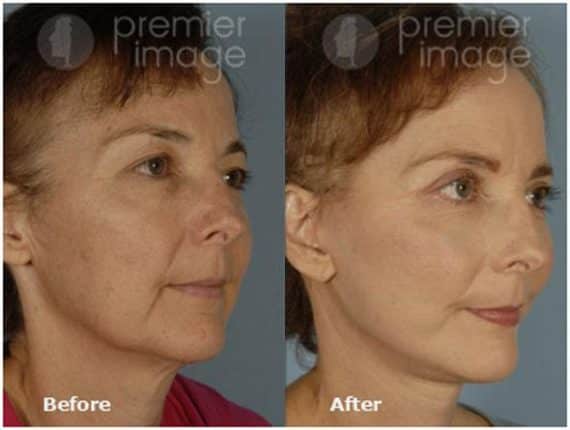 QT Mini-Facelift Before and after photos in Sandy Springs, GA, Patient 16147