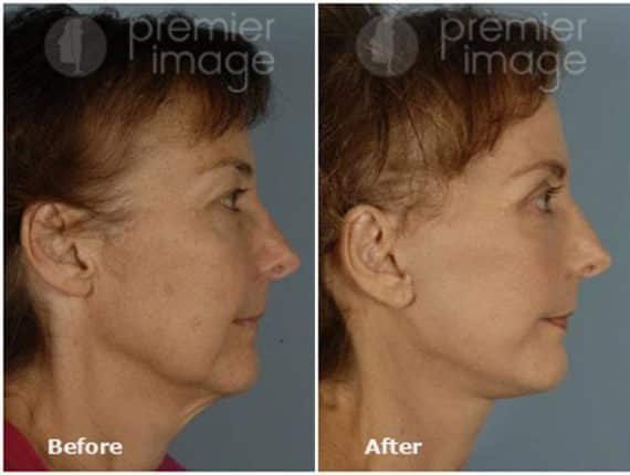 QT Mini-Facelift Before and after photos in Sandy Springs, GA, Patient 16147