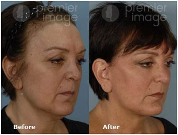 QT Mini-Facelift Before and after photos in Sandy Springs, GA, Patient 16152