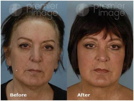 QT Mini-Facelift Before and after photos in Sandy Springs, GA, Patient 16152