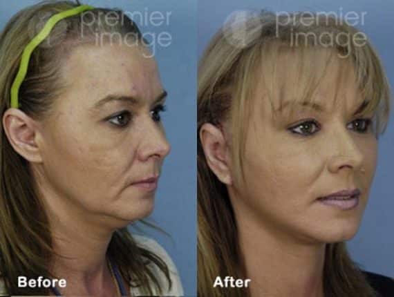 QT Mini-Facelift Before and after photos in Sandy Springs, GA, Patient 16159