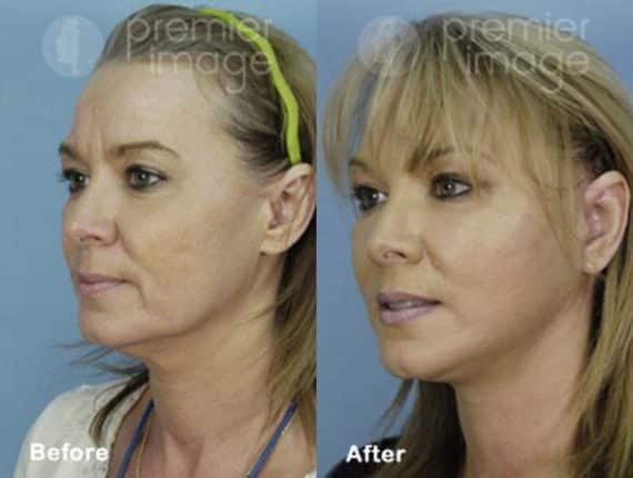 QT Mini-Facelift Before and after photos in Sandy Springs, GA, Patient 16159