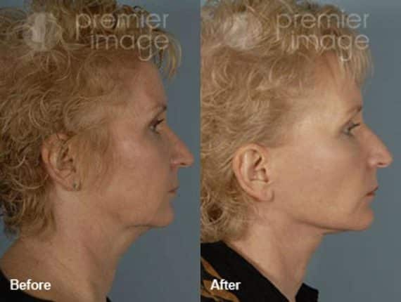 QT Mini-Facelift Before and after photos in Sandy Springs, GA, Patient 16164