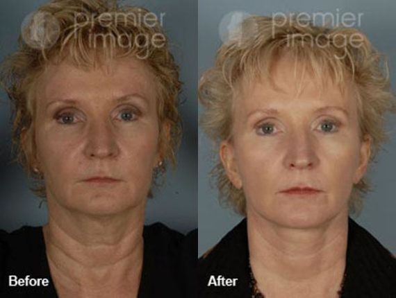 QT Mini-Facelift Before and after photos in Sandy Springs, GA, Patient 16164