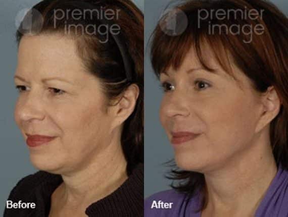 QT Mini-Facelift Before and after photos in Sandy Springs, GA, Patient 16173