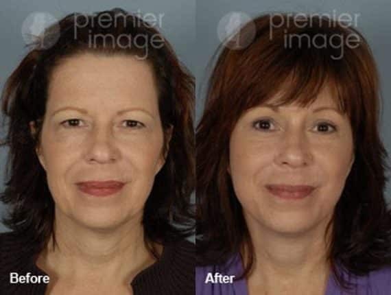 QT Mini-Facelift Before and after photos in Sandy Springs, GA, Patient 16173