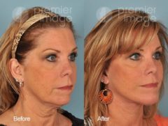 QT Mini-Facelift Before and after photos in Sandy Springs, GA, Patient 16187