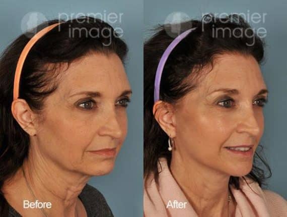 QT Mini-Facelift Before and after photos in Sandy Springs, GA, Patient 16194