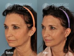 QT Mini-Facelift Before and after photos in Sandy Springs, GA, Patient 16194