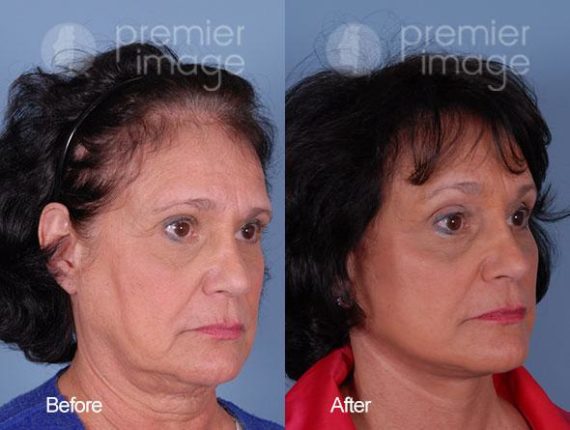 QT Mini-Facelift Before and after photos in Sandy Springs, GA, Patient 16199