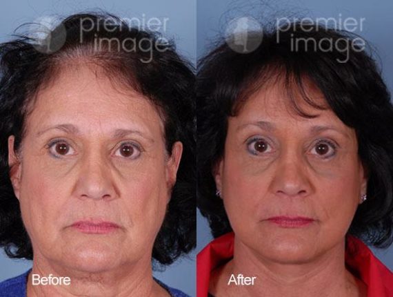 QT Mini-Facelift Before and after photos in Sandy Springs, GA, Patient 16199