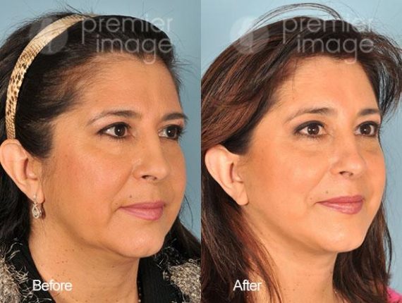 QT Mini-Facelift Before and after photos in Sandy Springs, GA, Patient 16208