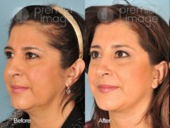 QT Mini-Facelift Before and after photos in Sandy Springs, GA, Patient 16208