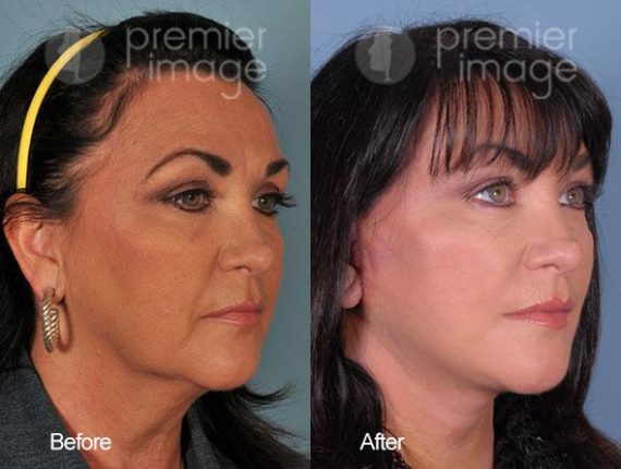 QT Mini-Facelift Before and after photos in Sandy Springs, GA, Patient 16213