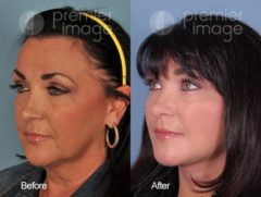 QT Mini-Facelift Before and after photos in Sandy Springs, GA, Patient 16213