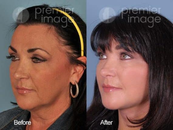 QT Mini-Facelift Before and after photos in Sandy Springs, GA, Patient 16213