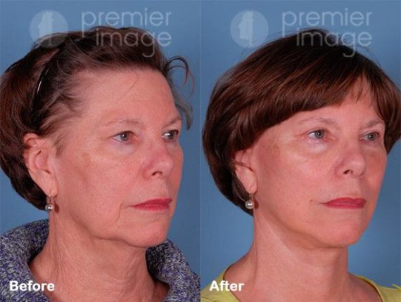 QT Mini-Facelift Before and after photos in Sandy Springs, GA, Patient 16223