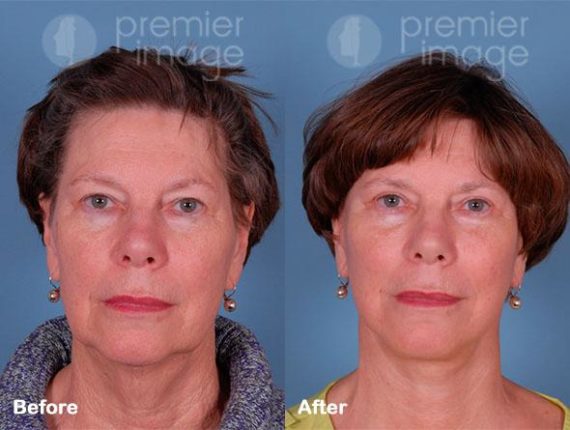 QT Mini-Facelift Before and after photos in Sandy Springs, GA, Patient 16223