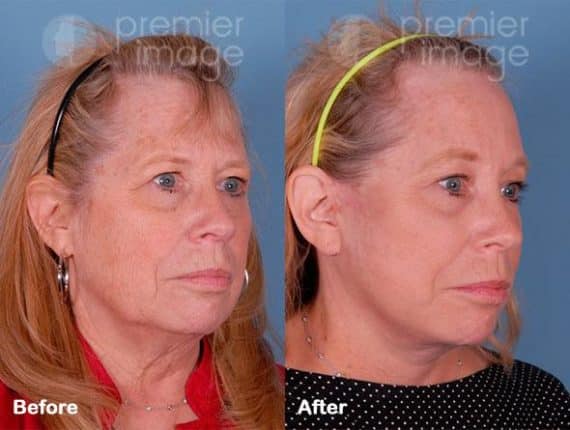 QT Mini-Facelift Before and after photos in Sandy Springs, GA, Patient 16230