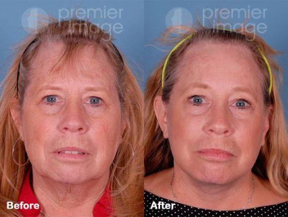 QT Mini-Facelift Before and after photos in Sandy Springs, GA, Patient 16230