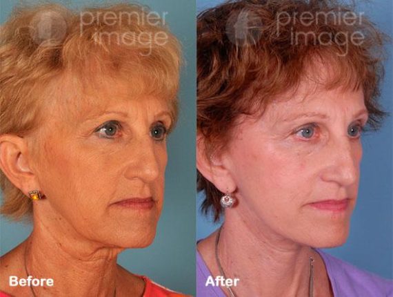 QT Mini-Facelift Before and after photos in Sandy Springs, GA, Patient 16237