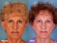 QT Mini-Facelift Before and after photos in Sandy Springs, GA, Patient 16237