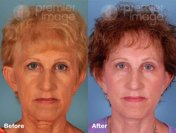 Facelift Pre-Operative Instructions