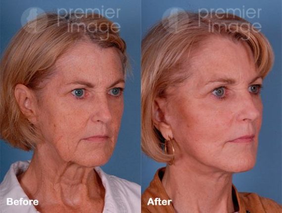 QT Mini-Facelift Before and after photos in Sandy Springs, GA, Patient 16244