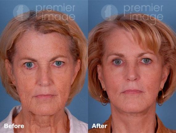 QT Mini-Facelift Before and after photos in Sandy Springs, GA, Patient 16244