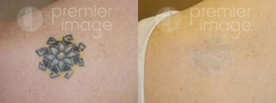 Tattoo Removal Before and after photos in Sandy Springs, GA, Patient 16259