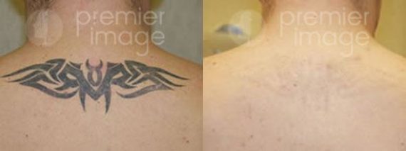 Tattoo Removal Before and after photos in Sandy Springs, GA, Patient 16262