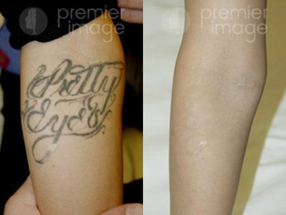 Tattoo Removal Before and after photos in Sandy Springs, GA, Patient 16268