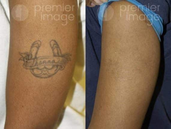 Tattoo Removal Before and after photos in Sandy Springs, GA, Patient 16271