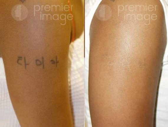 Tattoo Removal Before and after photos in Sandy Springs, GA, Patient 16274