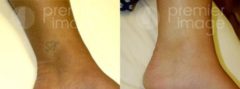  Eliminación de Tatuajes Fotos Antes y Después en Sandy Springs, GA, Patient 20009