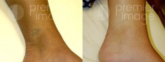 Tattoo Removal Before and after photos in Sandy Springs, GA, Patient 16277