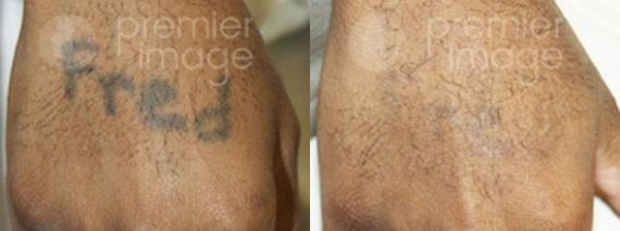 Tattoo Removal Before and after photos in Sandy Springs, GA, Patient 16280