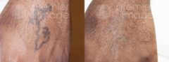 Tattoo Removal Before and after photos in Sandy Springs, GA, Patient 16283