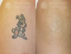 Tattoo Removal Before and after photos in Sandy Springs, GA, Patient 16286