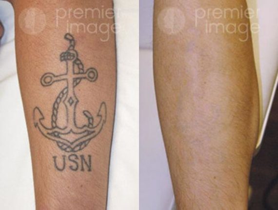 Tattoo Removal Before and after photos in Sandy Springs, GA, Patient 16289