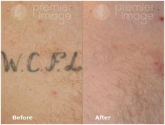 Tattoo Removal Before and after photos in Sandy Springs, GA, Patient 16292