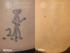 Tattoo Removal Before and after photos in Sandy Springs, GA, Patient 16295