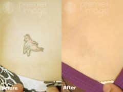 Tattoo Removal Before and after photos in Sandy Springs, GA, Patient 16298