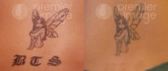 Tattoo Removal Before and after photos in Sandy Springs, GA, Patient 16301