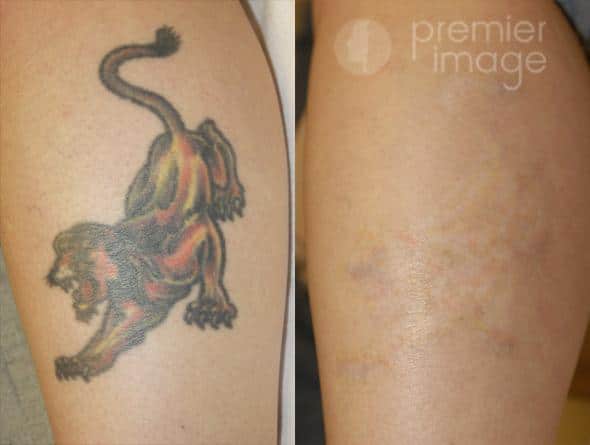 Tattoo Removal Before and after Sandy Springs, GA Patient 16304
