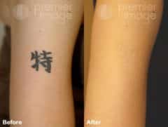 Tattoo Removal Before and after photos in Sandy Springs, GA, Patient 16307